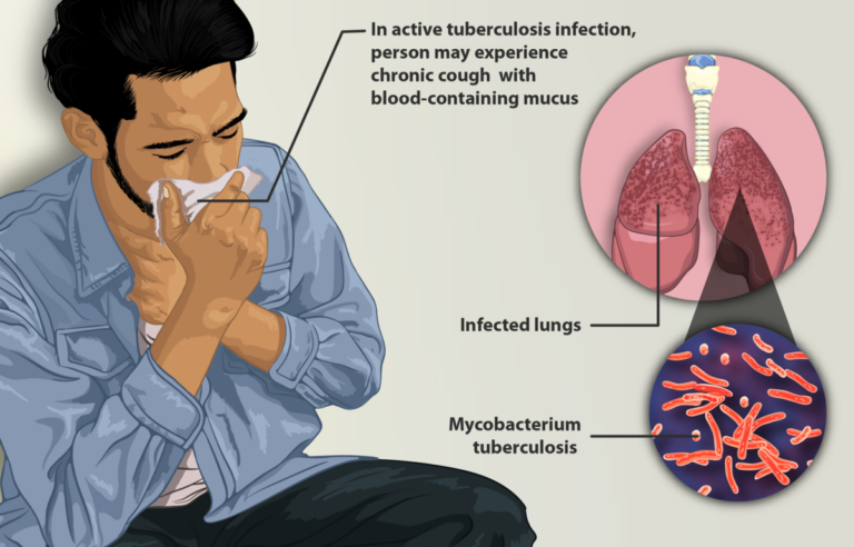 El 43 % de los casos de tuberculosis son detectados en el Gran Santo Domingo
