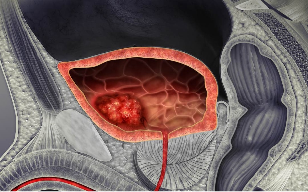 El cáncer de vejiga afecta más a hombres fumadores, pero tampoco perdona a las mujeres