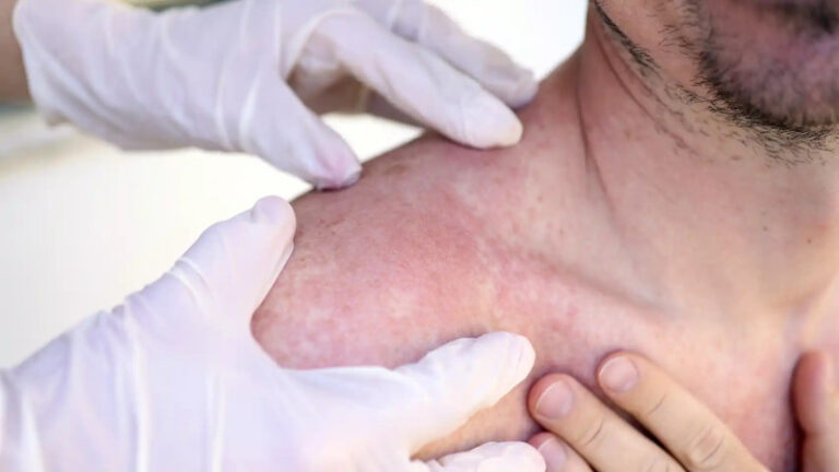 El Instituto Dermatológico detecta 266 casos de cáncer de piel en dos meses
