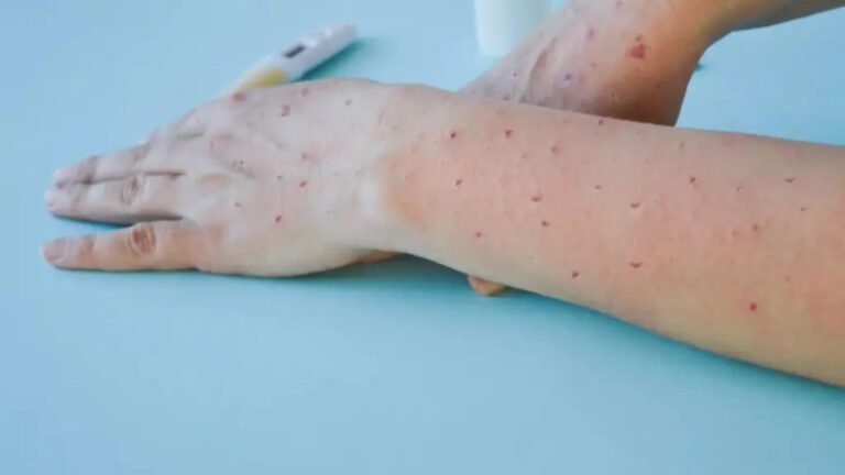 Emiten alerta epidemiológica por viruela del mono