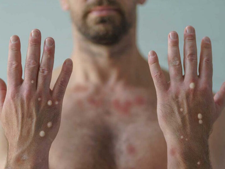 Se han detectado ocho casos de viruela símica en 2024