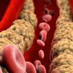 El colesterol alto: un enemigo silencioso que podemos vencer desde la infancia
