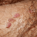 Haití anuncia campaña de vacunación contra el papiloma