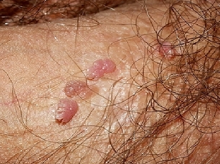 Haití anuncia campaña de vacunación contra el papiloma