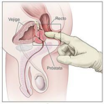 Eyaculación y Cáncer de Próstata: Aclaraciones necesarias