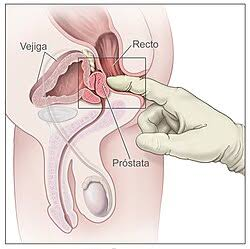 Eyaculación y Cáncer de Próstata: Aclaraciones necesarias